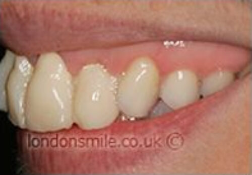Case-6-6-b Before Image - The London Smile Clinic