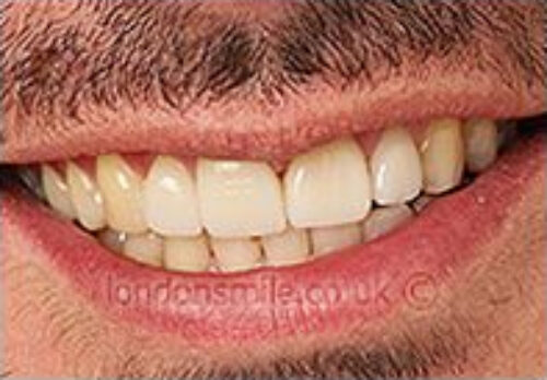 Case-6-8-a After Image - The London Smile Clinic