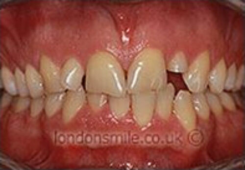 Case-6-8-b Before Image - The London Smile Clinic