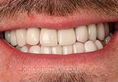 After Image - The London Smile Clinic