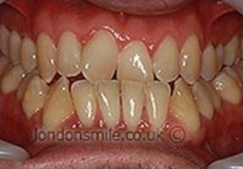Before Image - The London Smile Clinic