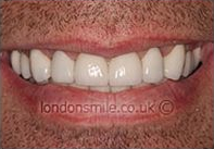 After Image - The London Smile Clinic