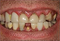 Before Image - The London Smile Clinic