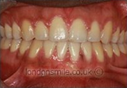 After Image - The London Smile Clinic
