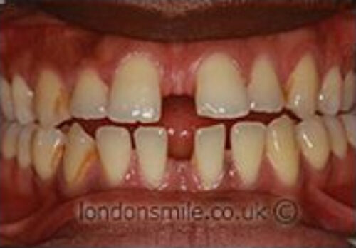 Before Image - The London Smile Clinic