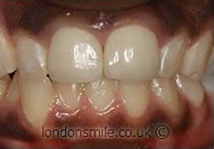 Before Image - The London Smile Clinic