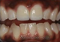 After Image - The London Smile Clinic