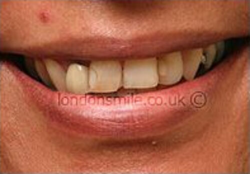 old-crowns-case1-a After Image - The London Smile Clinic