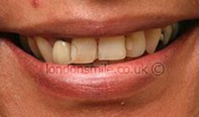 old-crowns-case1-b