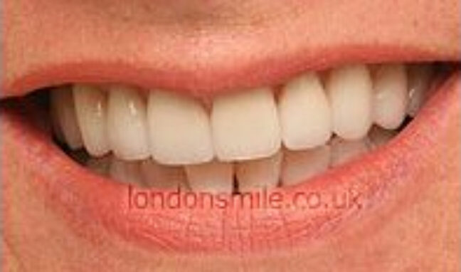 protruding-case4-a
