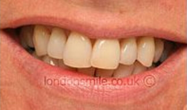 protruding-case4-b