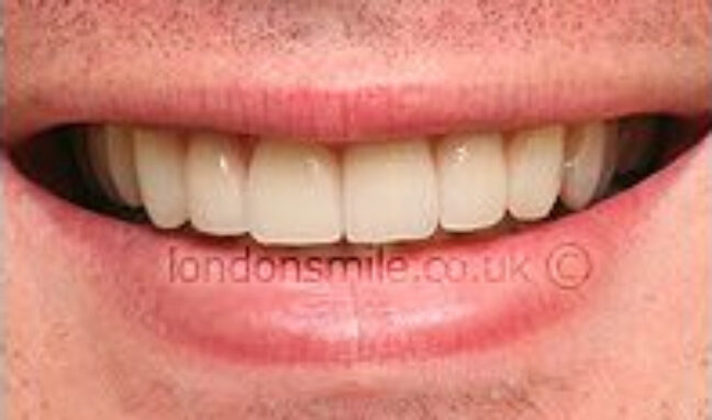 protruding-case7-a