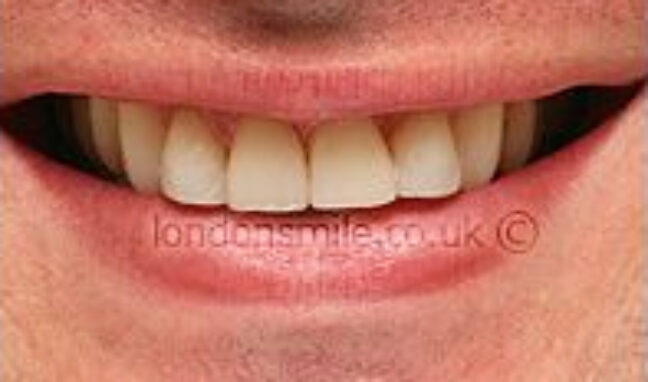 protruding-case7-b