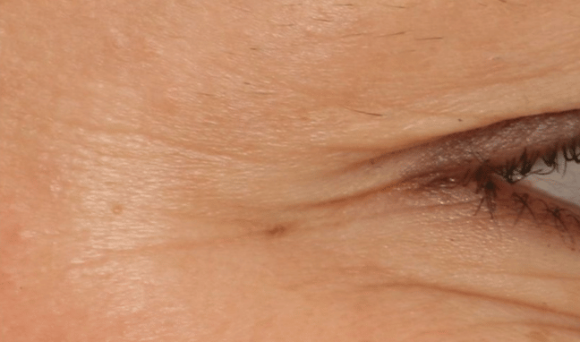 Facial Aesthetics Case 1a