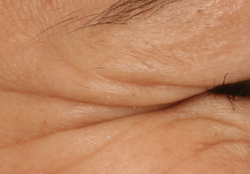 Before Image - The London Smile Clinic