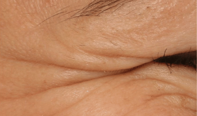 Facial Aesthetics Case 1b