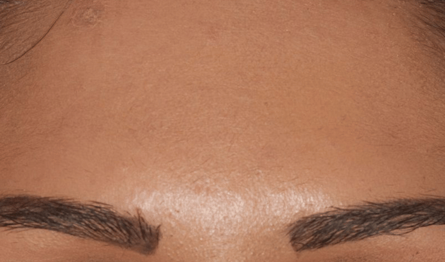 Facial Aesthetics Case 3a