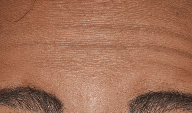 Facial Aesthetics Case 3b