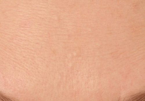 After Image - The London Smile Clinic