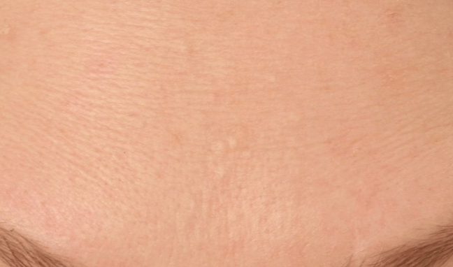 Facial Aesthetics Case 4a
