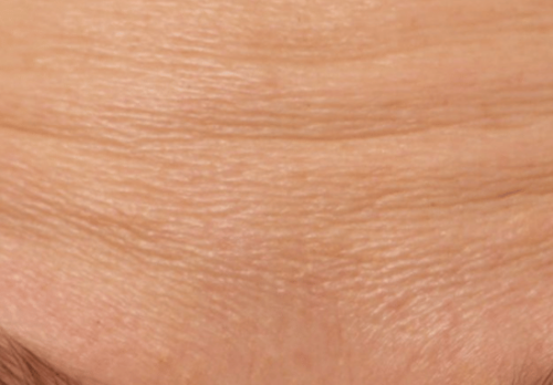 Before Image - The London Smile Clinic