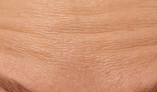 Facial Aesthetics Case 4b