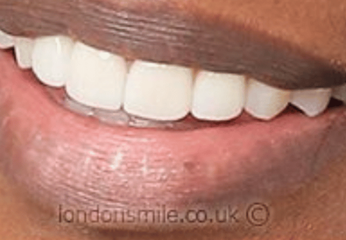 Veneers Case 1a After Image - The London Smile Clinic