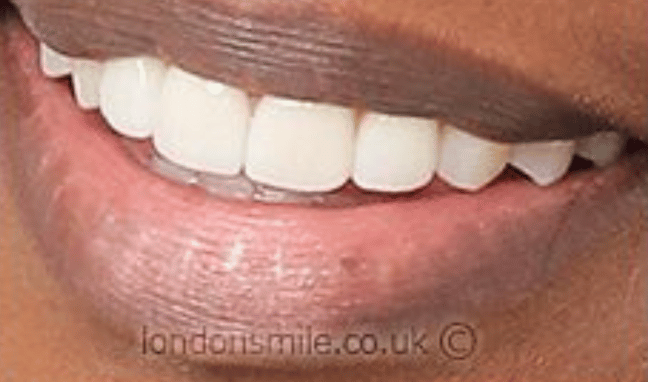 Veneers Case 1a