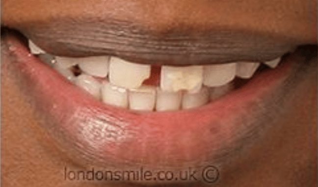 Veneers Case 1b