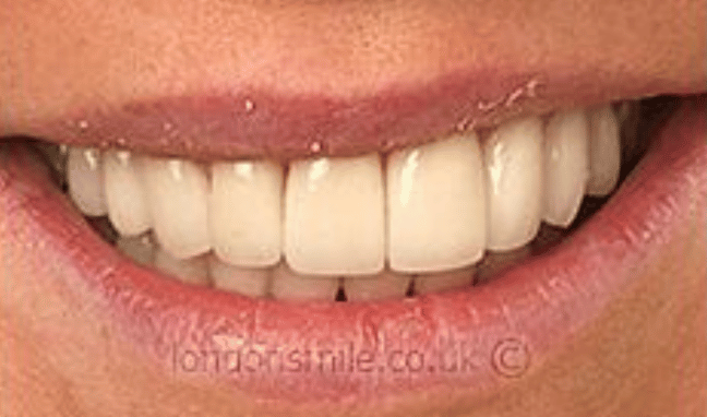Veneers Case 2a