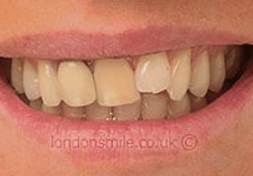 Veneers Case 2b Before Image - The London Smile Clinic