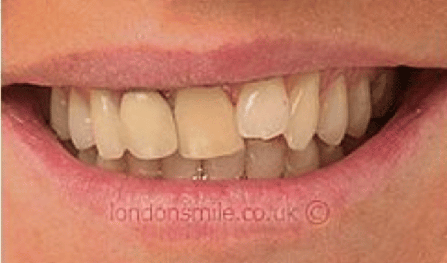 Veneers Case 2b