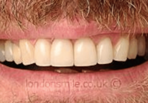Veneers Case 3a After Image - The London Smile Clinic