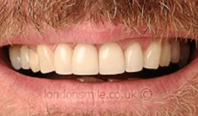 Veneers Case 3a
