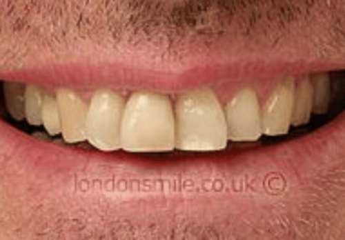 Veneers Case 3b Before Image - The London Smile Clinic
