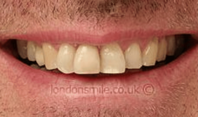 Veneers Case 3b