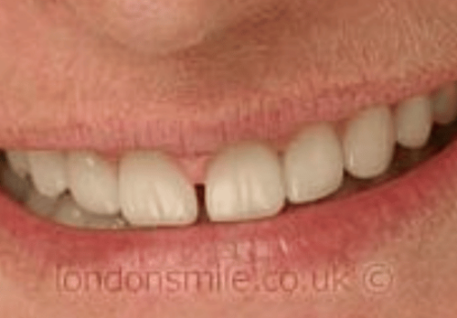 Veneers Case 4a After Image - The London Smile Clinic