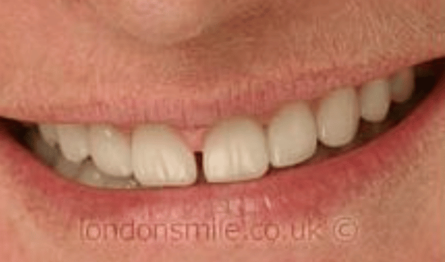 Veneers Case 4a