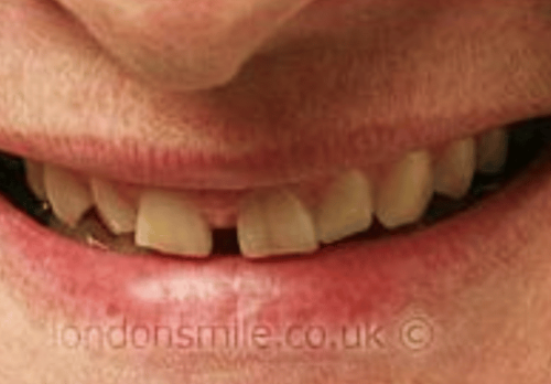 Veneers Case 4b Before Image - The London Smile Clinic