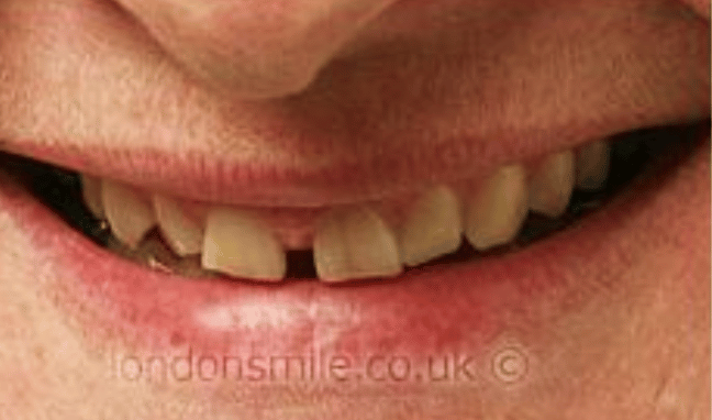Veneers Case 4b