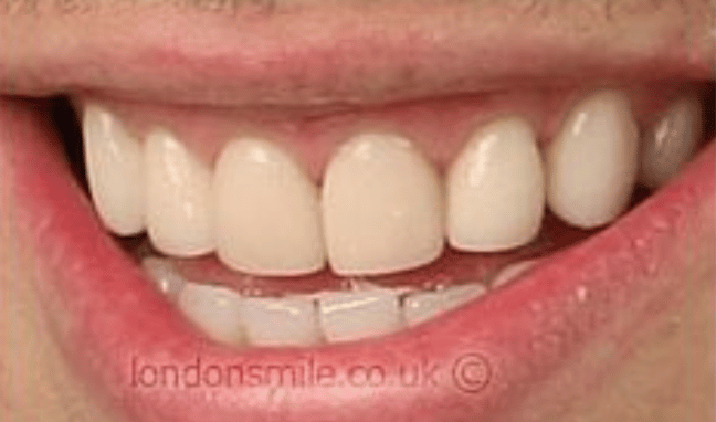 Whitening Case 1a