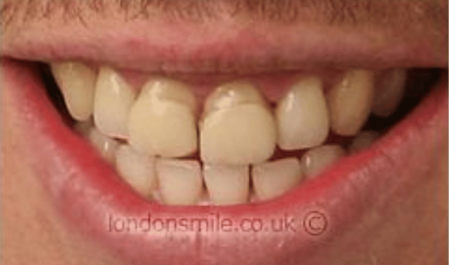 Whitening Case 1b