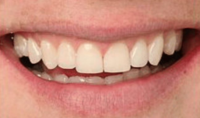 Whitening Case 2a