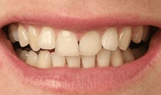 Whitening Case 2b