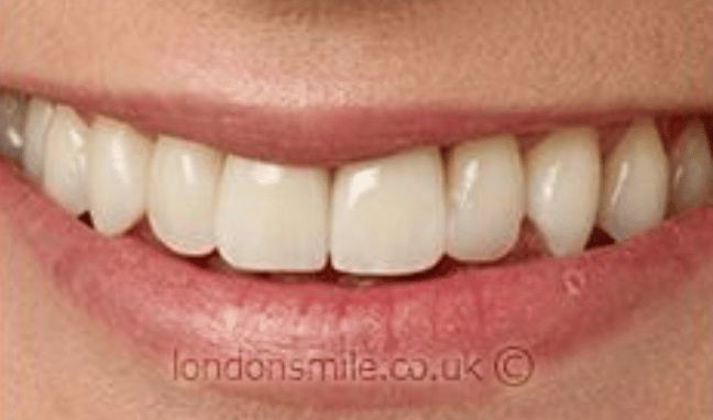Whitening Case 3a
