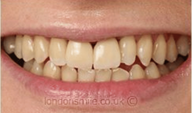 Whitening Case 3b