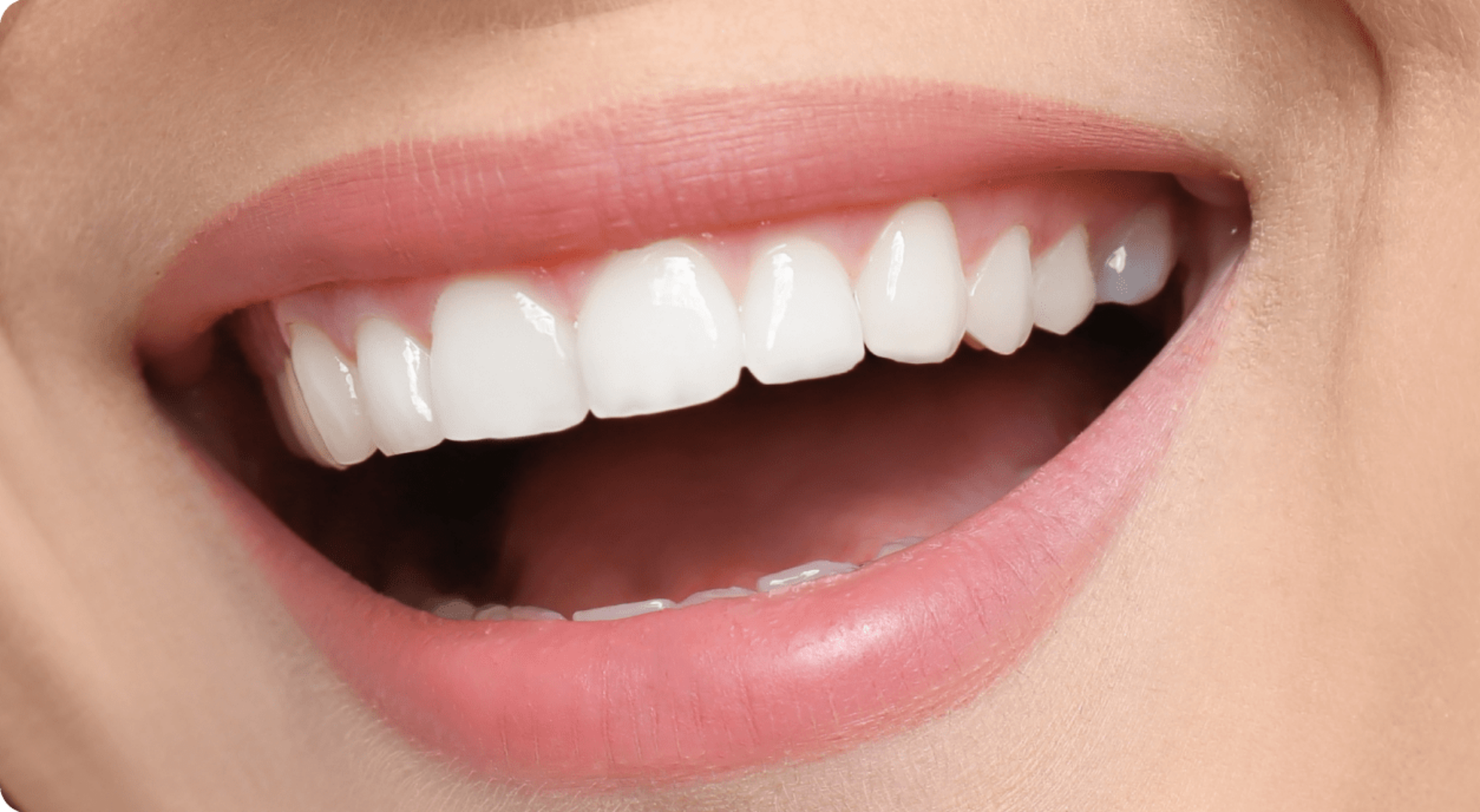Porcelain Veneers Overview Image - The London Smile Clinic