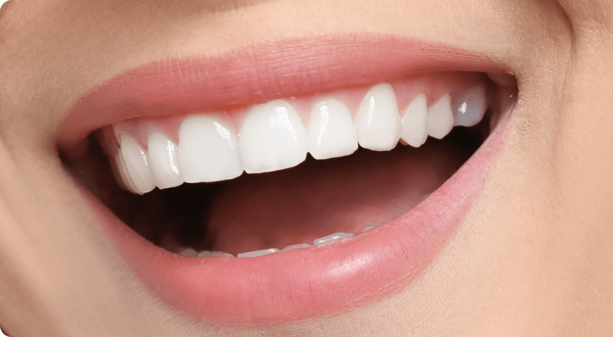 Porcelain Veneers Treatment Image - The London Smile Clinic