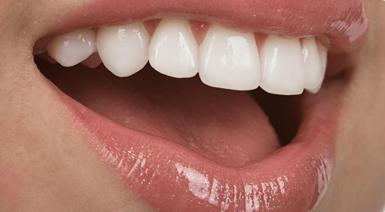 Composite Bonding Treatment Image - The London Smile Clinic