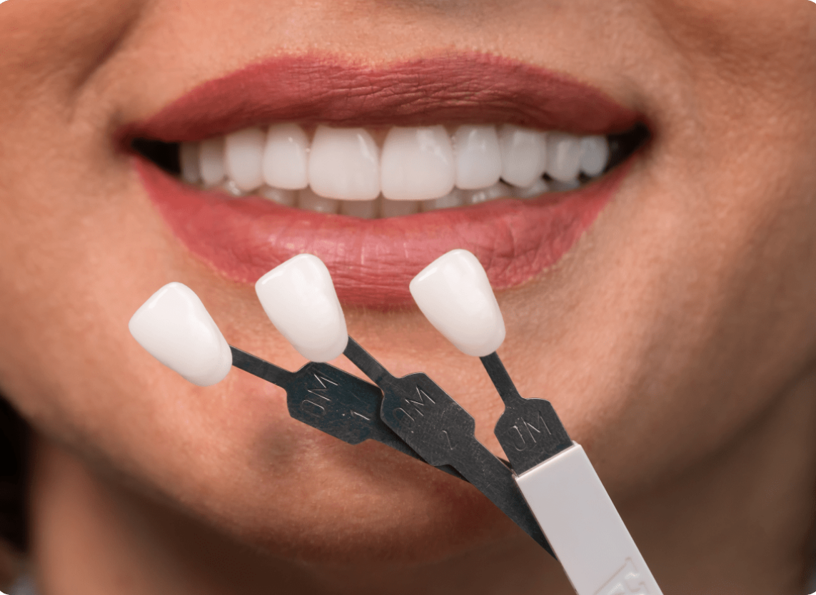 Fitting Procedure Image - The London Smile Clinic